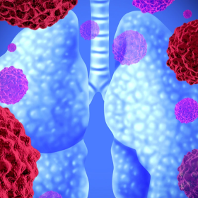 Tìm hiểu về ung thư phổi không tế bào nhỏ giai đoạn III