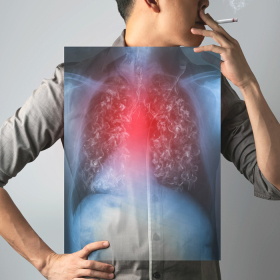 Tìm hiểu ung thư phổi tế bào nhỏ​: Triệu chứng, giai đoạn và điều trị