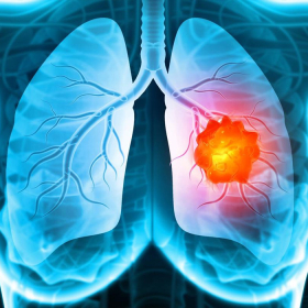 Những điều bạn cần biết về ung thư phổi thứ phát