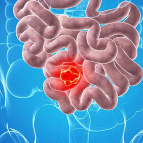 Ung thư ruột non: Nguyên nhân, triệu chứng và cách điều trị mới nhất