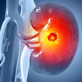 Ung thư thận là gì? Nguyên nhân, triệu chứng và cách điều trị