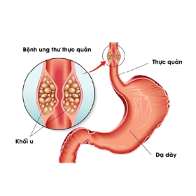 Ung thư thực quản là gì? Nguyên nhân, dấu hiệu và cách điều trị