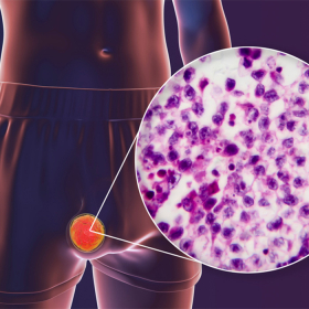 Ung thư tinh hoàn là gì? Nguyên nhân, dấu hiệu và điều trị hiện nay