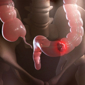 Ung thư trực tràng là gì? Nguyên nhân, triệu chứng và chẩn đoán