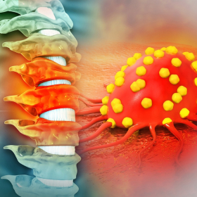 Ung thư tủy sống nguy hiểm mức nào? Những điều cần hiểu đúng