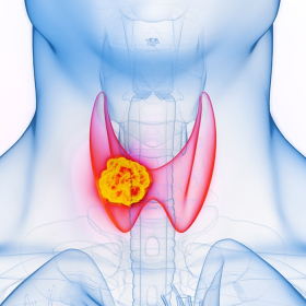 Ung thư tuyến giáp giai đoạn 2 là gì? Dấu hiệu và cách điều trị hiệu quả