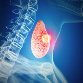 Ung thư tuyến giáp giai đoạn 2 sống được bao lâu? Điều trị dứt điểm không