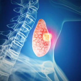 Người bị ung thư tuyến giáp giai đoạn 3 sống được bao lâu theo bác sĩ?