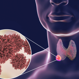 Ung thư tuyến giáp: Nguyên nhân, triệu chứng và cách điều trị