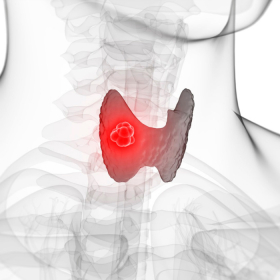Ung thư tuyến giáp thể nhú sống được bao lâu? Tiên lượng sống