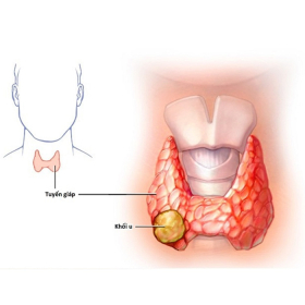 Ung thư tuyến giáp thể tủy: Nguyên nhân, triệu chứng và cách điều trị
