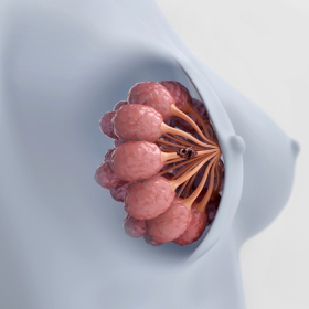 Ung thư vú chuyển sản là gì? 90% phụ nữ không biết điều này