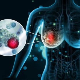 Ung thư vú có di truyền không? Những điều nhiều người hiểu sai