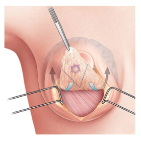 Ung thư vú có nên mổ không? Lựa chọn phương pháp điều trị phù hợp