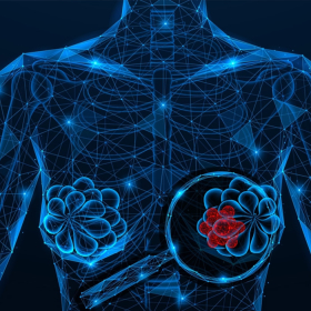 Ung thư vú dạng nhú là bệnh gì? Những điều cần biết