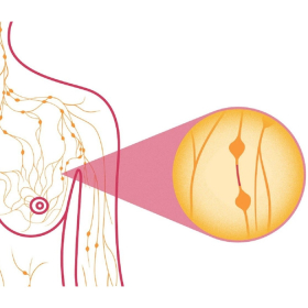 Ung thư vú dạng viêm: Nguyên nhân, triệu chứng và điều trị mới nhất