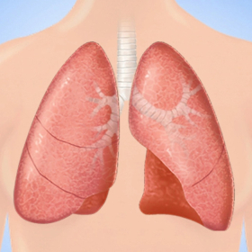 Ung thư vú di căn đến đâu và dấu hiệu nhận biết không nên bỏ qua