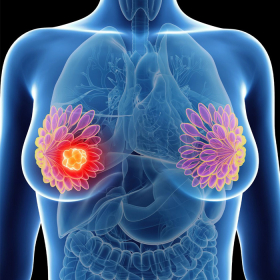 Ung thư vú di căn phổi có chữa được không? Những điều người bệnh cần biết