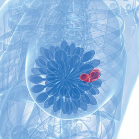 Tất tần tật về ung thư vú thể tủy: Hiểu đúng để không hoang mang