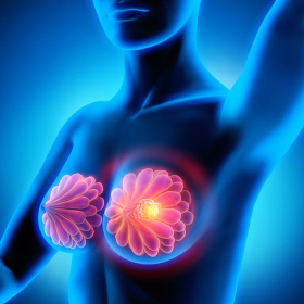 Ung thư vú tiểu thùy xâm nhập: Những điều bạn cần biết