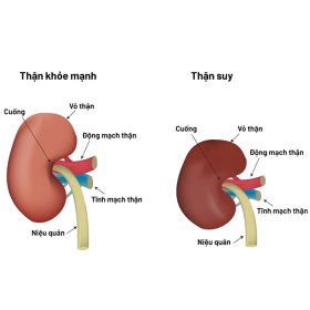 Vì sao suy thận đang có xu hướng trẻ hóa? Nguyên nhân do đâu?