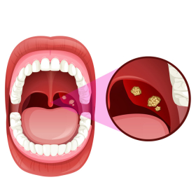 Sự thật về viêm họng hạt có gây ung thư vòm họng không?