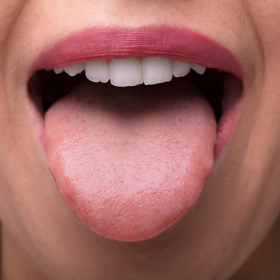 Viêm lưỡi là gì? Nguyên nhân, triệu chứng và cách điều trị hiệu quả