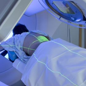 Phương pháp xạ trị điều trị u lympho không Hodgkin