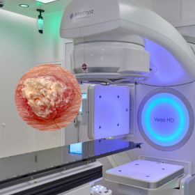 Xạ trị điều trị ung thư da: Phương pháp, quy trình thực hiện và tác dụng phụ