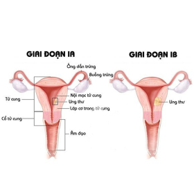 Xem hình ảnh ung thư cổ tử cung qua các giai đoạn