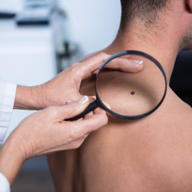 Quá trình xét nghiệm ung thư da và các lưu ý cần biết khi xét nghiệm 
