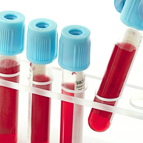 Tìm hiểu xét nghiệm ung thư phổi gồm những loại nào?